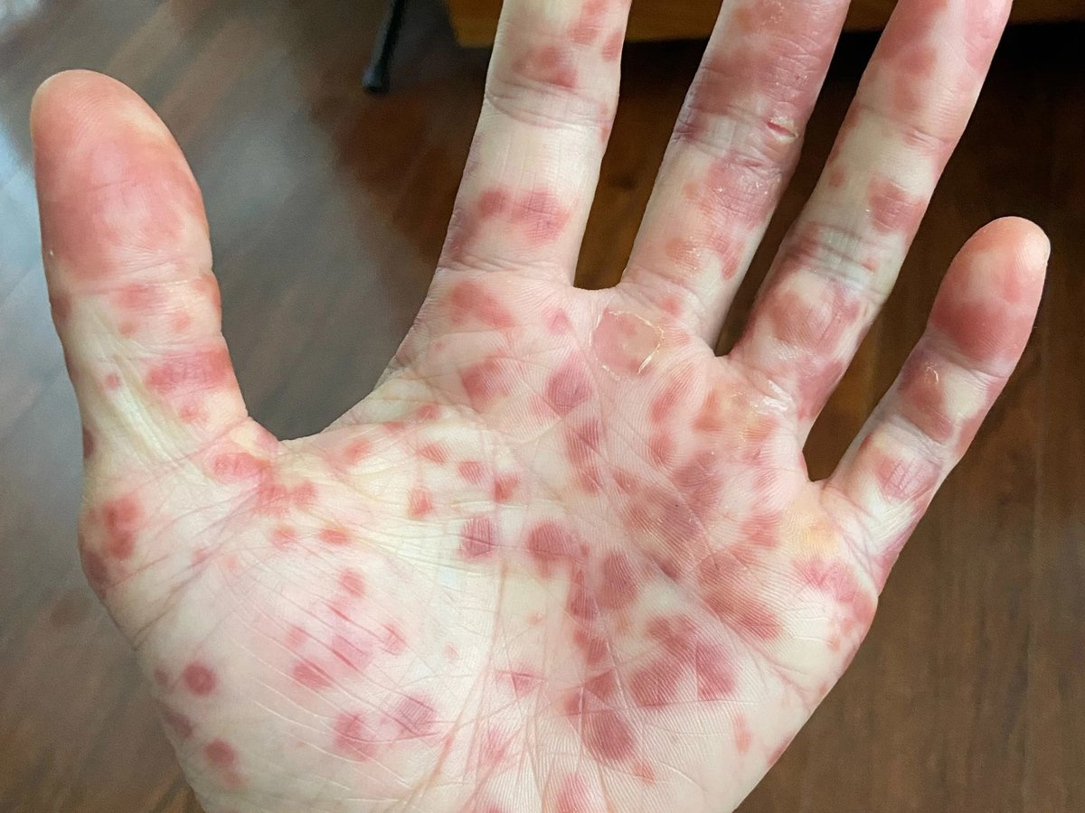 It took multiple telehealth appointments, and trips to urgent care clinics and emergency rooms before an infectious disease specialist diagnosed Kevin Kwong with monkeypox.