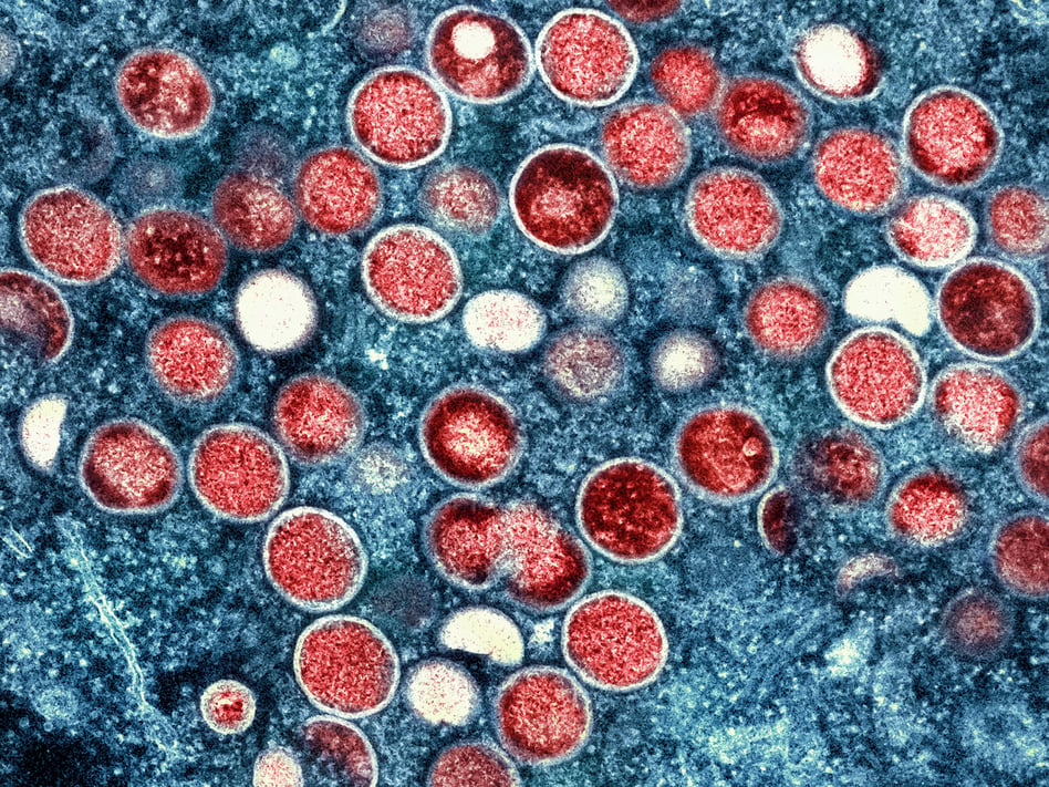Studies show that monkeypox isn't easy to catch from respiratory droplets or contaminated objects. It's one of the reasons that the virus hasn't spread more widely in the U.S.