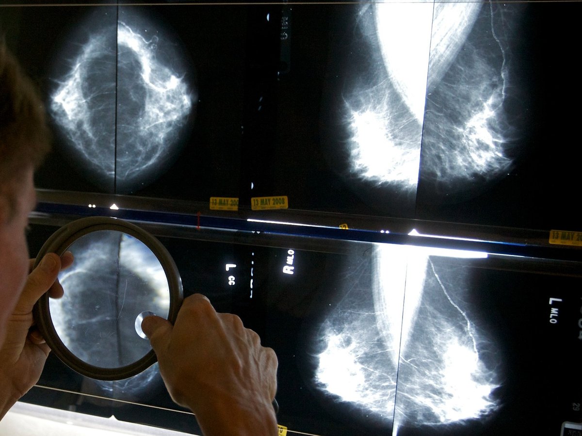 A radiologist uses a magnifying glass to check mammograms for breast cancer in Los Angeles, May 6, 2010.