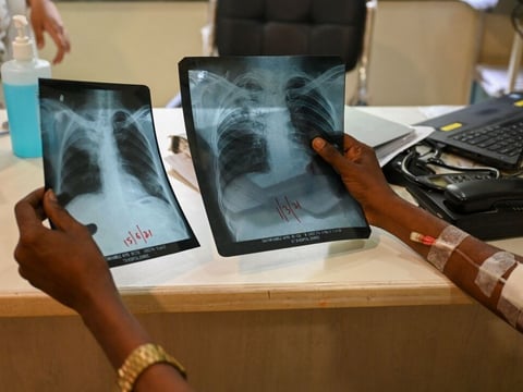 A patient who was diagnosed with tuberculosis holds his chest x-rays while consulting with a doctor at the Médecins Sans Frontières clinic in Mumbai, which treats people with drug-resistant tuberculosis.